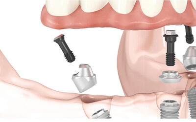 protesi-toronto-bridge-dentista-agosto-udine